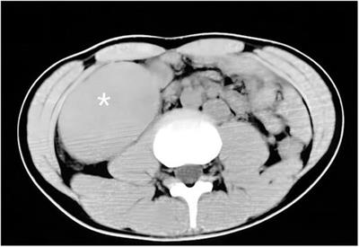 A case report of wandering spleen with pedicle torsion and splenic infarction being misdiagnosed as organ inversion complicated with acute appendicitis